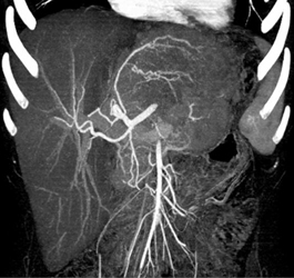 Hepatoma - CTisus CT Scan