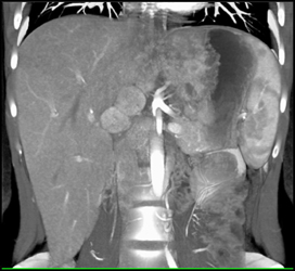 Hepatoma - CTisus CT Scan