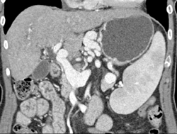 Cirrhosis and ?? - CTisus CT Scan