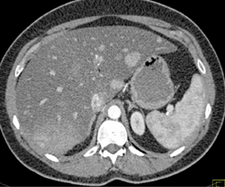 Regenerating Nodules - CTisus CT Scan