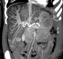 Regenerating Nodules - CTisus CT Scan