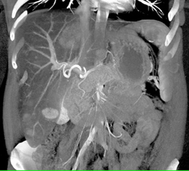 Regenerating Nodules - CTisus CT Scan