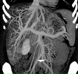 Regenerating Nodules - CTisus CT Scan