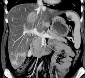 Regenerating Nodules - CTisus CT Scan