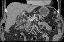 Tumor Infiltrates the Distal Common Bile Duct (CBD) - CTisus CT Scan