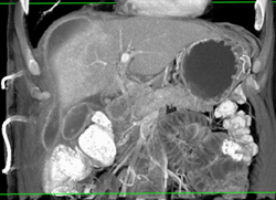 ?? Subcapsular Hematoma - CTisus CT Scan