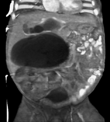 Choledochal Cyst - CTisus CT Scan