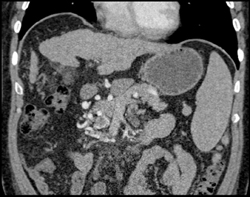 Median Arcuate Ligament ?? With Collaterals - CTisus CT Scan