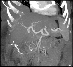 Normal Hepatic Artery - CTisus CT Scan