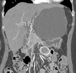 Giant Hepatic Cyst and Small Bowel Gist - CTisus CT Scan