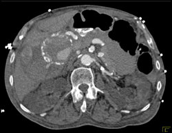 Hepatic Artery Aneurysm - CTisus CT Scan