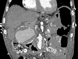 Hepatic Artery Aneurysm - CTisus CT Scan