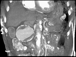 Hepatic Artery Aneurysm - CTisus CT Scan