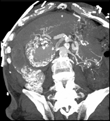 Hepatic Artery Aneurysm - CTisus CT Scan