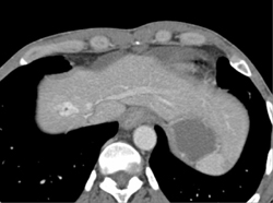 Focal Nodular Hyperplasia (FNH) - CTisus CT Scan