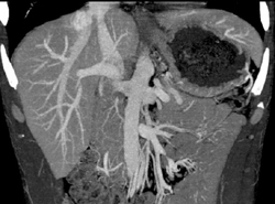 Focal Nodular Hyperplasia (FNH) - CTisus CT Scan