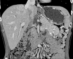 Islet Cell Involves the Portal Vein With Collaterals - CTisus CT Scan