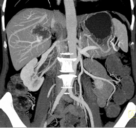 Hemangioma - CTisus CT Scan