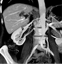 Hemangioma - CTisus CT Scan