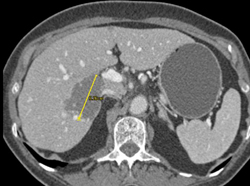 Hemangioma - CTisus CT Scan