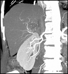 Hemangioma - CTisus CT Scan