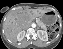 Lymphoma Infiltrates Hilum of the Liver - CTisus CT Scan