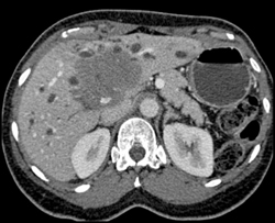 Hepatic Lymphoma Encases Hepatic Artery and Portal Vein - CTisus CT Scan