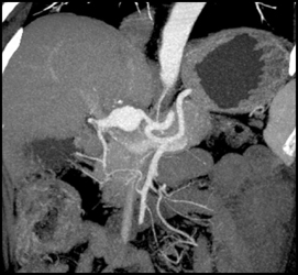 Hepatic Artery Aneurysm - CTisus CT Scan