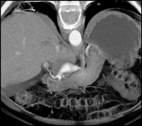 Hepatic Artery Aneurysm - CTisus CT Scan