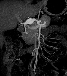 Hepatic Artery Aneurysm - CTisus CT Scan