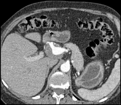 Hepatic Artery Aneurysm - CTisus CT Scan