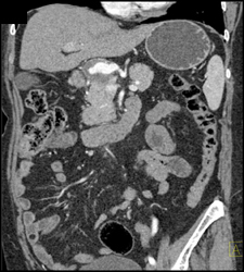 Hepatic Artery Aneurysm - CTisus CT Scan