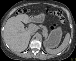 Hepatic Artery Aneurysm - CTisus CT Scan