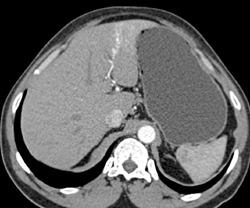 Focal Nodular Hyperplasia (FNH) With Prominent Vascularity - CTisus CT Scan