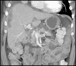 Liver Infarct S/P Transplant - CTisus CT Scan