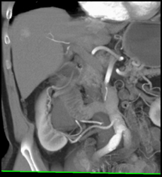 Hepatoma - CTisus CT Scan