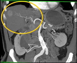 Hepatoma - CTisus CT Scan