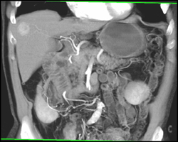 Hepatoma - CTisus CT Scan