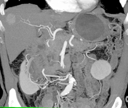 Hepatoma - CTisus CT Scan