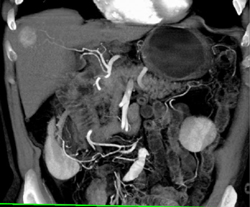 Hepatoma - CTisus CT Scan