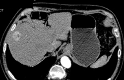 Hepatoma - CTisus CT Scan