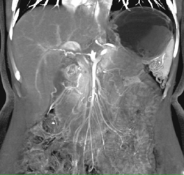 Encased Hepatic Artery - CTisus CT Scan