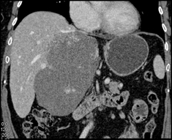 Giant Cavernous Hemangioma - CTisus CT Scan