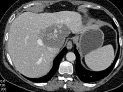 Giant Cavernous Hemangioma - CTisus CT Scan