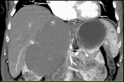 Giant Cavernous Hemangioma - CTisus CT Scan