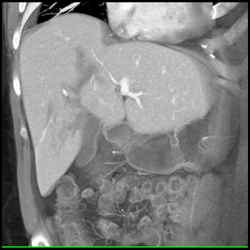 Liver Laceration - CTisus CT Scan