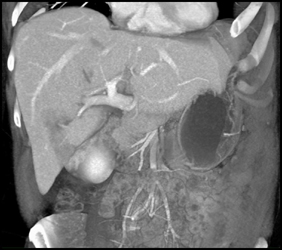 Liver Laceration - CTisus CT Scan