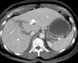 Liver Laceration - CTisus CT Scan