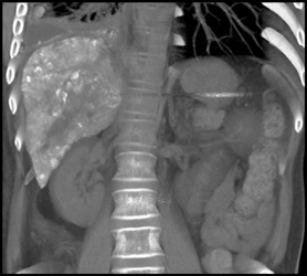 Post Chemoembolization - CTisus CT Scan