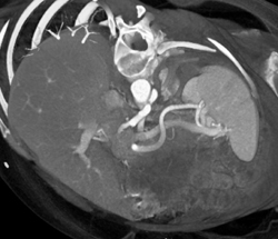 Av-shunting - CTisus CT Scan